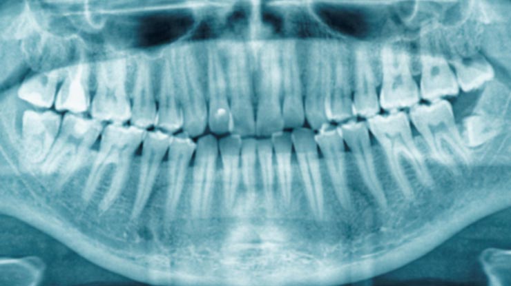 4. Panoramic Rontgen Gigi dan Rongga Mulut